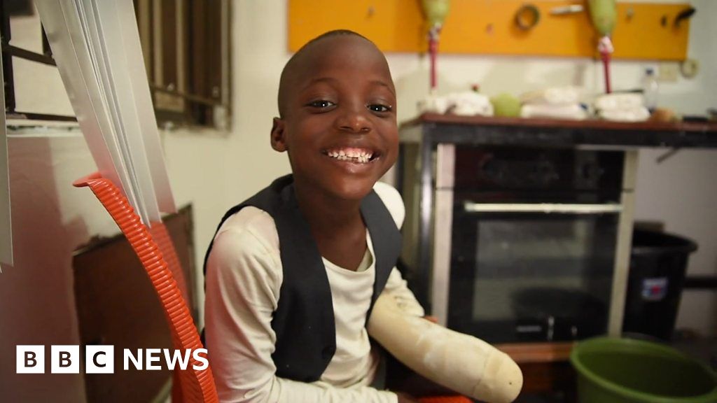 Making prosthetic limbs for Nigerian children